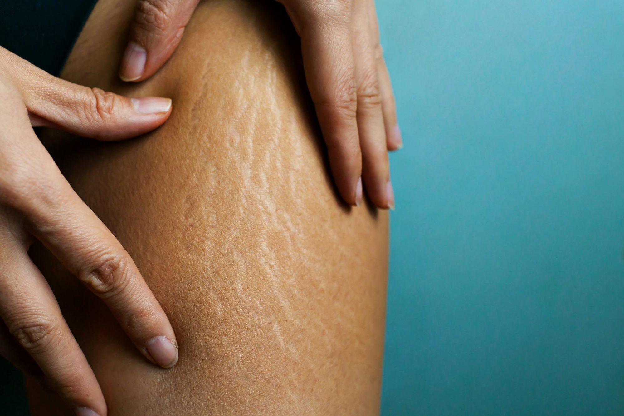 what-are-the-causes-of-stretch-marks-aislac